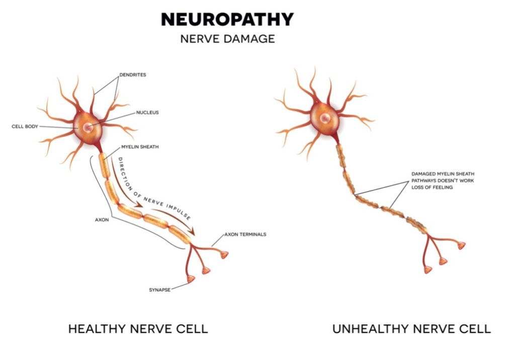 Medical diagram of a normal nerve and a damaged nerve